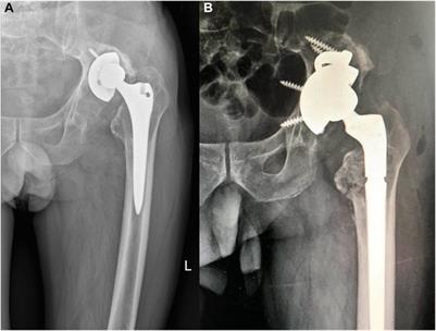Revision total hip arthroplasty using a fluted, tapered, modular stem follow-up method for a mean of three years: A preliminary study